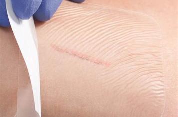 ‘POLYSKIN’ for treatment of chronic ulcers